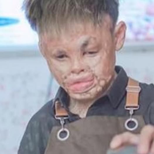 Boy with facial deformities chasing his dream