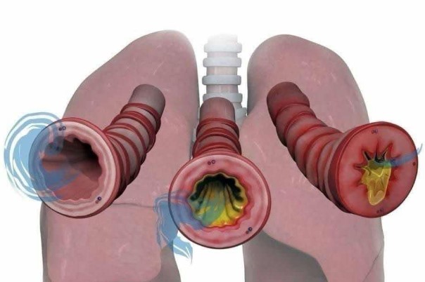 How to Naturally Clear Phlegm and Mucus from Chest and Throat